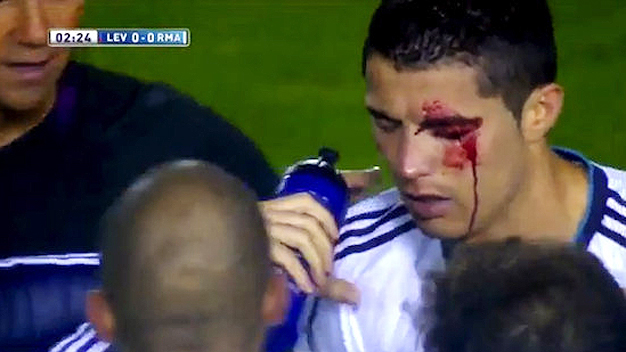 Tổn thương mắt, Ronaldo lỡ trận BĐN gặp Gabon Tổn thương mắt, Ronaldo lỡ trận BĐN gặp Gabon